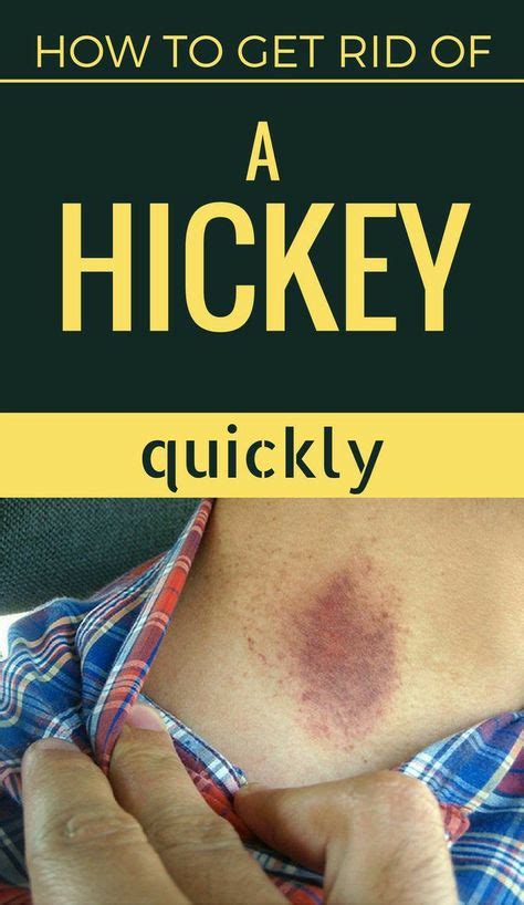 How To Remove Or Hide A Hickey Love Bite Fast How To Hide Hickeys