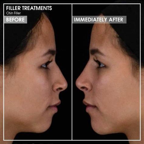 Dermal Fillers Volumising And Enhancing Treatments