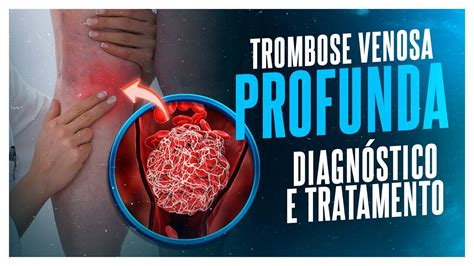 Trombose Venosa Profunda Diagn Stico E Tratamento Youtube