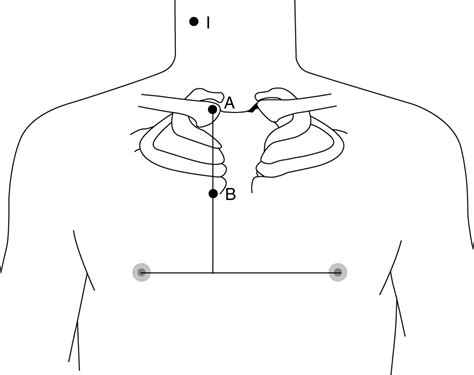 Subclavian Vein Central Line Landmarks