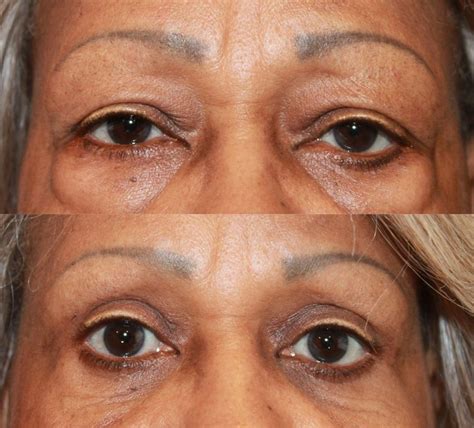 Eyelid Surgery Fort Lauderdale And Boca Raton Blepharoplasty