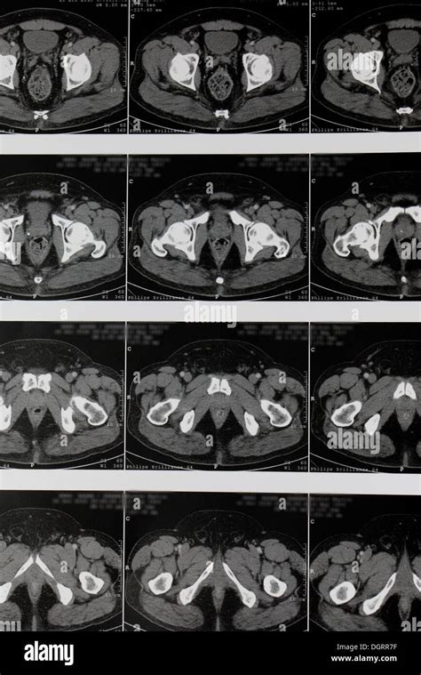 Multi Slice Computed Tomography Magnetic Resonance Imaging Mri Examination Of The Internal