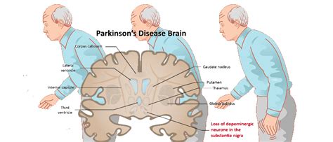 Parkinson's Disease | Symptoms | Causes | Complications | Remedies