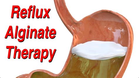 Reflux Alginate Therapy - All Natural Way to Manage Acid or Non-Acidic ...