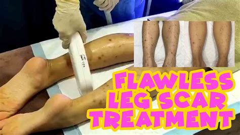 Flawless Leg Scar Treatment Laser Light Skin Centre YouTube