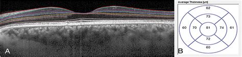 Outer Nuclear Layer Thinning In Pachychoroid Pigment Epithel Retina