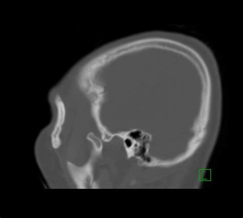 Bilateral Temporomandibular Joint Dislocation Image