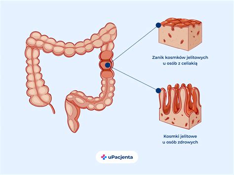 Celiakia objawy Jakie badania wykonać