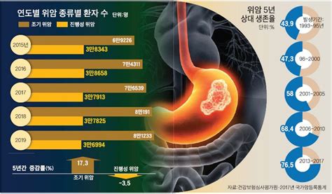 5년 생존율 77 위암 20 재발돼 추적 검사해야 미주중앙일보