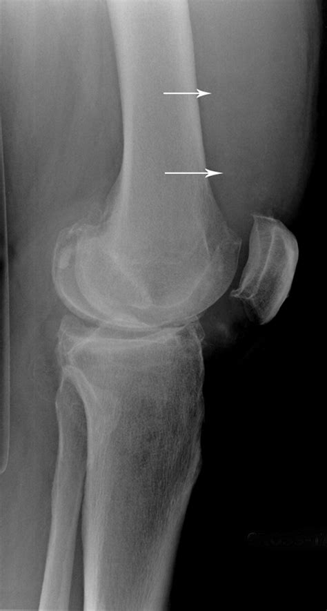 Ajr Teaching File An Uncommon Cause Of Knee Swelling Ajr