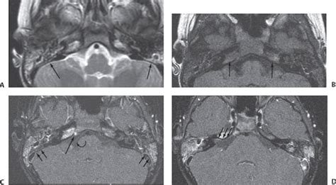 Petrous Apicitis | Radiology Key