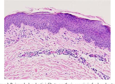 Erythema Annulare Centrifugum Histology