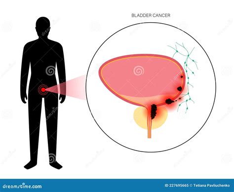 Bladder Cancer Stages Stock Vector Illustration Of Ureter 227695665