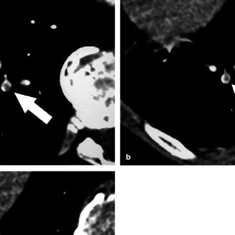 Pdf Ct Diagnosis Of Acute Pulmonary Embolism