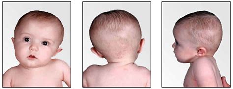 Congenital Torticollis Causes Symptoms Diagnosis Treatment Exercises