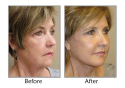 What Is The Recovery Time Ater a facelift? | SLC, Utah