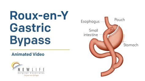 Roux En Y Gastric Bypass Youtube