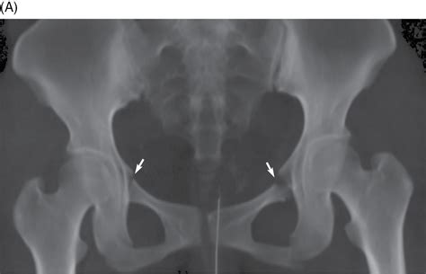 Superior Pubic Ramus Fracture