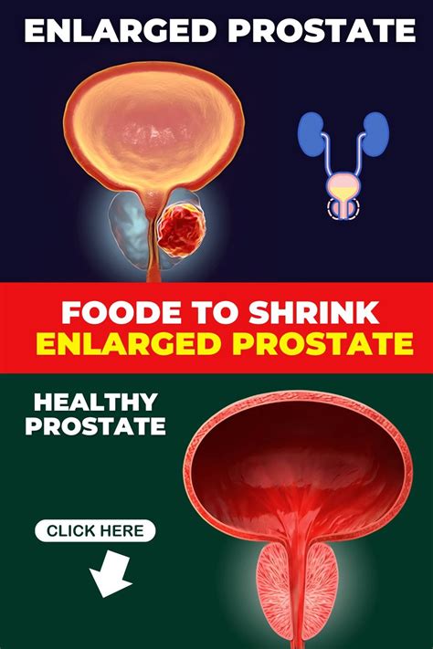 How To Shrink Enlarged Prostate Naturally Artofit