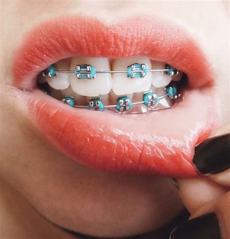 25+ bästa Light blue braces idéerna på Pinterest