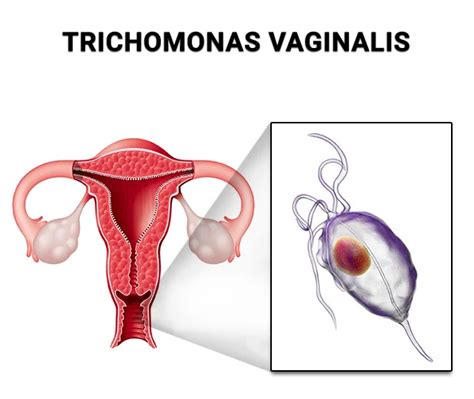 Trichomoniasis Why Routine Std Sti Testing Is Important