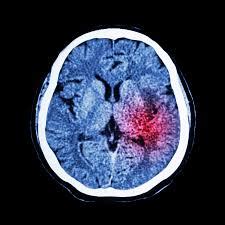 Intracranial hematoma