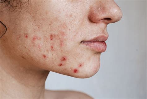 Effective Treatments For Deep Pitted Acne Scars A Guide To Restoring