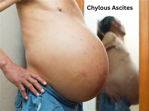 Chylous Ascites Treatment In Ayurveda