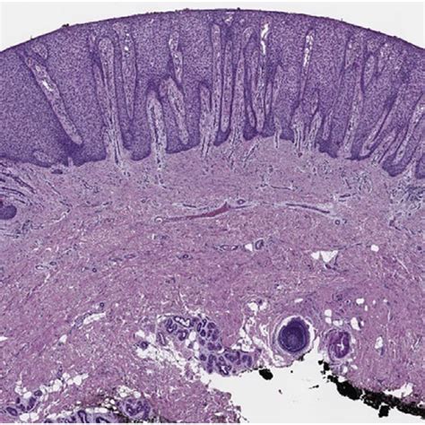 At Low Power View There Is A Very Well Demarcated Lesion With Prominent