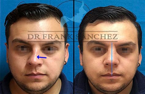 Rinoplastia Dr Frank S Nchez Rinoplastia Est Tica Y Funcional