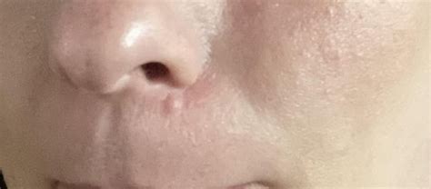 What is this bump by my nose? : r/Dermatology