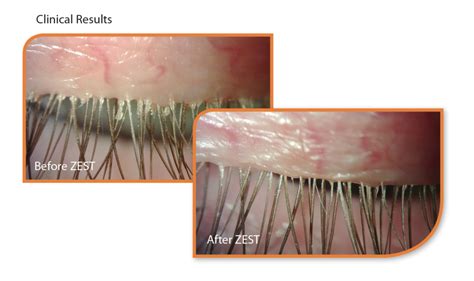 Introducing ZEST® Blepharitis and Dry Eye Treatment - Dry Eyes Clinic