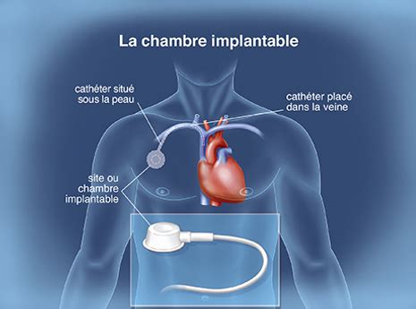 Chirurgien Digestif Bayonne Chambre Implantable