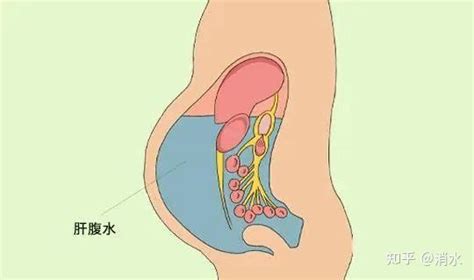 肝腹水的利尿药有哪些？ 知乎