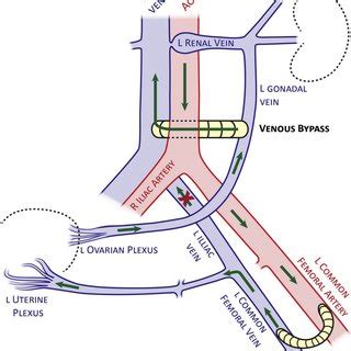 Anatomic diagram of postoperative anatomy after left gonadal vein (LGV)... | Download Scientific ...