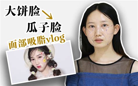 【吸脂瞿医生】面吸案例分享！女大学生面部长宽比例不协调、下巴后缩，七天秒变瓜子脸 哔哩哔哩 Bilibili