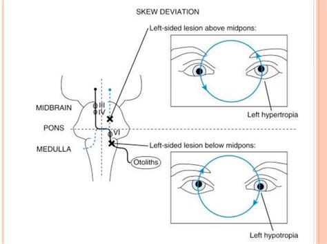 Diplopia approach | PPT