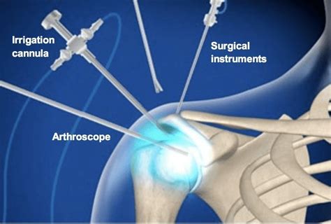 Diagnostic Arthroscopy Florida Surgery Consultants