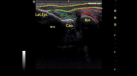 Radial Collateral Ligament And Annular Ligament Tear Elbow Ultrasound Youtube