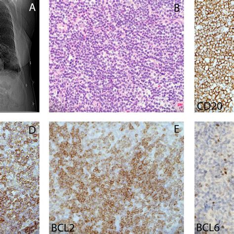 Extranodal Pleuropulmonary Marginal Zone Lymphoma A Ct Chest Showing Download Scientific