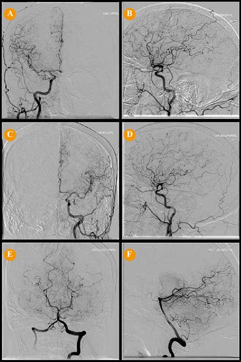 Cerebral Angiography Right Carotid Artery Injection Frontal A And