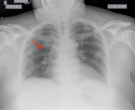 Vascular Congestion Chest X Ray