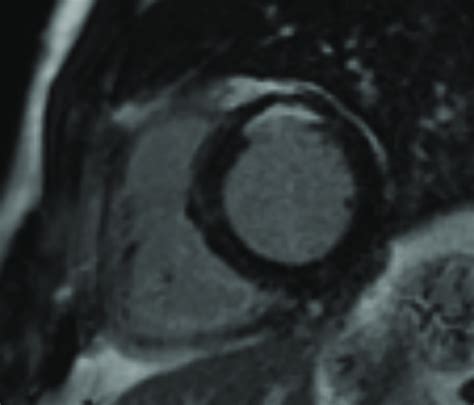 Unrecognized Myocardial Infarction As Detected With Cardiac Magnetic