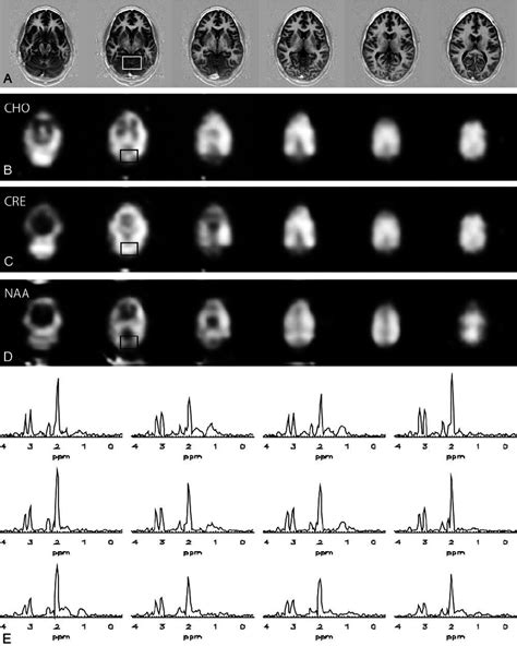 Multisection Multiple Spin Echo Mrsi With Etl At T Inversion