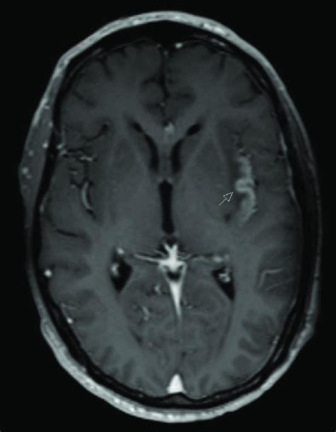 First Axial Contrast Enhanced T1 Weighted Magnetic Resonance Imaging