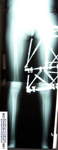 Femur Lengthening And Nonunion Repair After Tumor