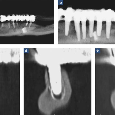 Preoperative And Control Radiographs Of Patient 1 A Preoperative Download Scientific Diagram