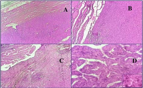 (A, B) Hurthle cell adenoma comprising of sheets of Hurthle cells and ...