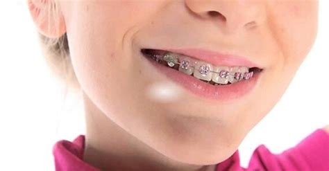 Metal ligature braces: description and cost | Axioma Dental