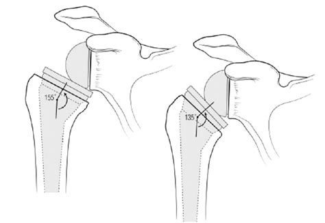 Shoulder Arthritis / Rotator Cuff Tears: causes of shoulder pain: Reverse total shoulder - the ...